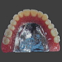 金属床義歯　保険適用外